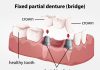 False Teeth – Dentures, Dental Partials and Denture Implants