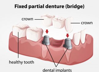 False Teeth – Dentures, Dental Partials and Denture Implants