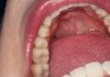 White Spots on Teeth