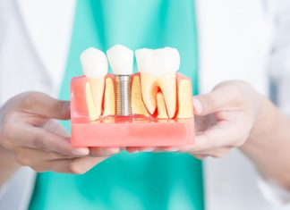 How Much Does a Tooth Implant Cost? Read This to Find Out