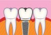 Mini Dental Implants Vs. Traditional Dental Implants