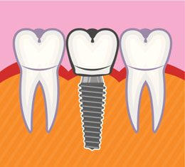 Mini Dental Implants Vs. Traditional Dental Implants
