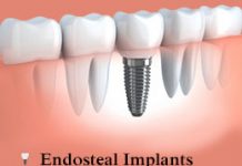 Types of Dental Implants Explained