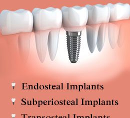 Types of Dental Implants Explained